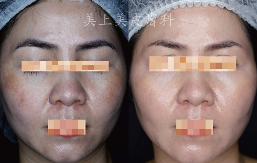 肝斑如何變淡？肝斑要擦什麼保養品？