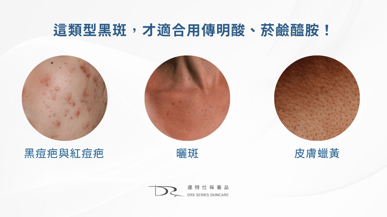 傳明酸、菸鹼醯胺一起用？韓國anua 美白精華液為何爆紅？