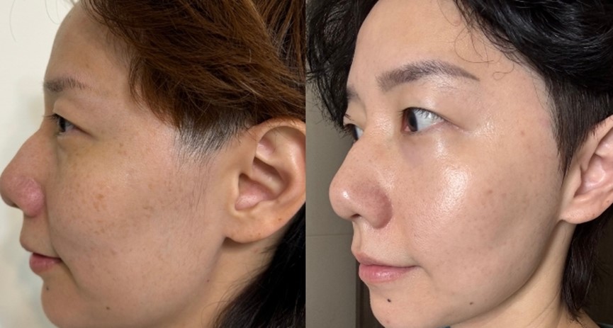 美白錠要吃多久才有效？ 傳明酸口服、穀胱甘肽點滴、美白針與口服維他命C美白完整攻略！