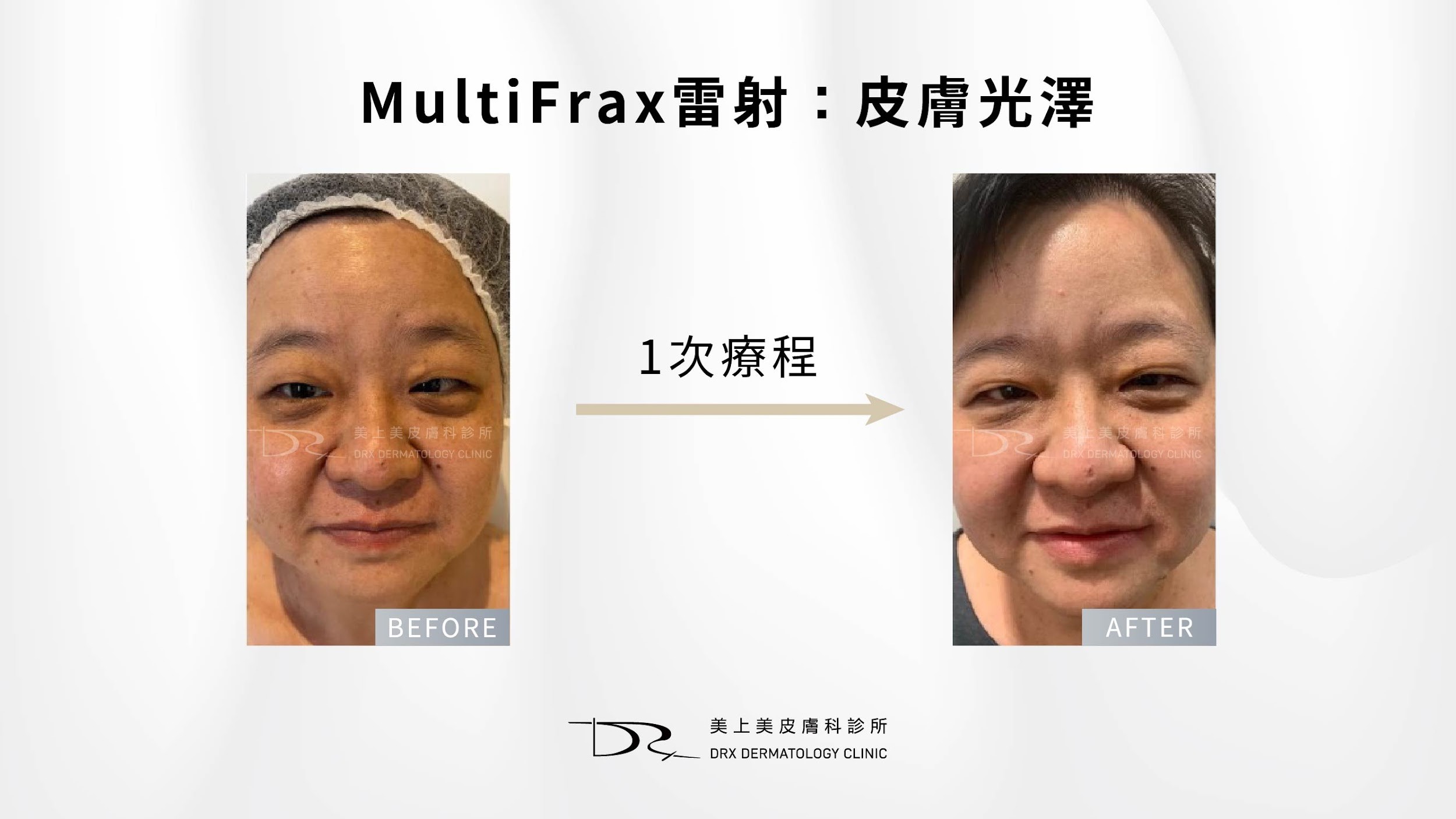 美白錠要吃多久才有效？ 傳明酸口服、穀胱甘肽點滴、美白針與口服維他命C美白完整攻略！