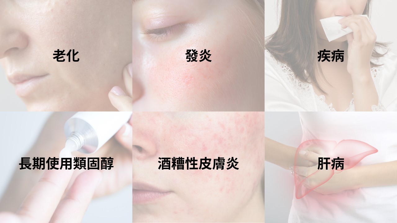 照鏡子總覺得臉上紅紅的一絲絲？為什麼臉上的血管越來越明顯？