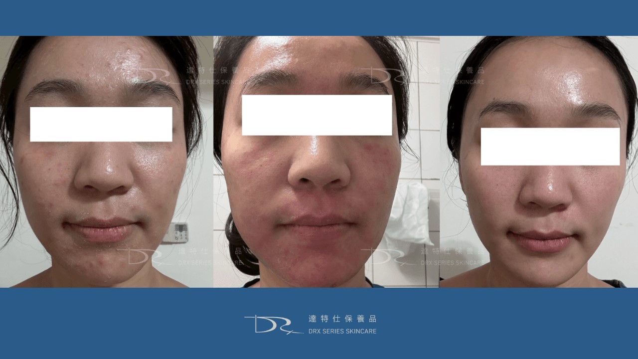 韓國微針精華的原理？微針精華功效？副作用是什麼？