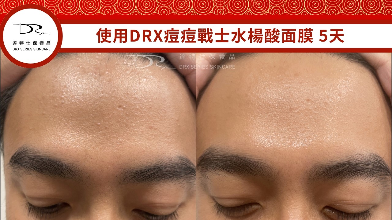 過年哪一天要熬夜？如何熬夜不長痘痘？