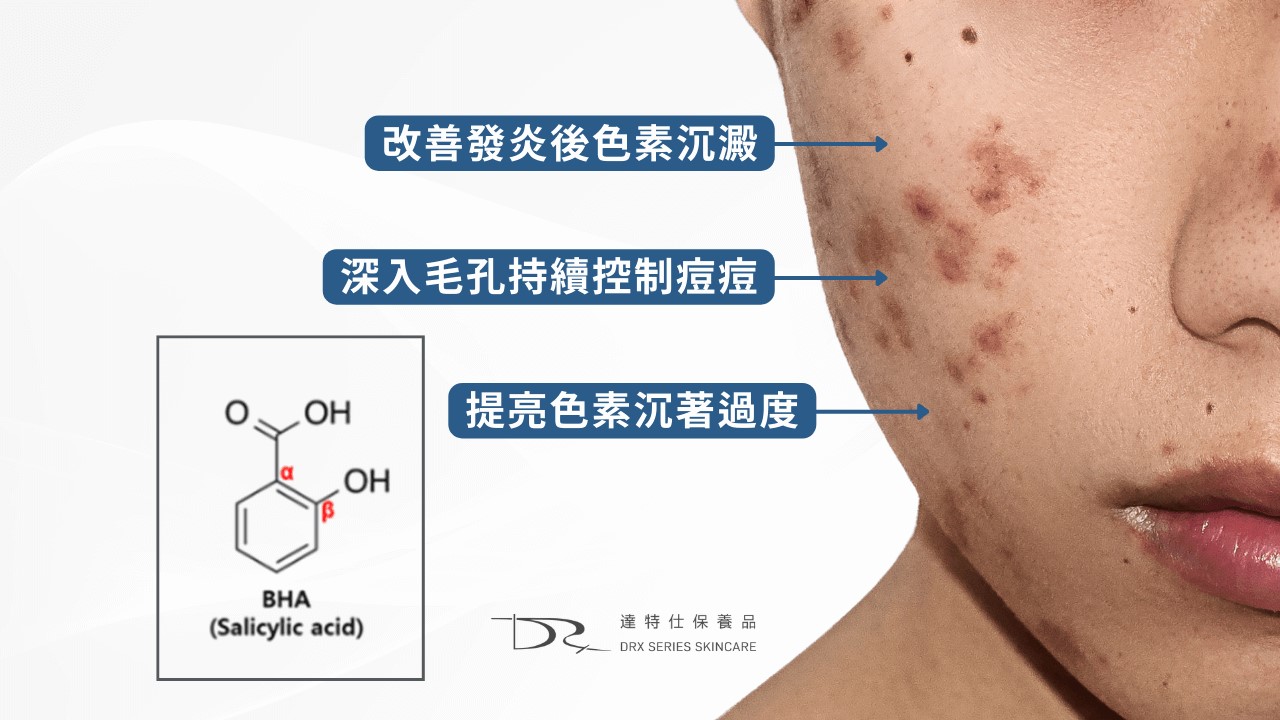 2026水楊酸功效完整解說:水楊酸會縮毛孔嗎? 水楊酸痘痘、水楊酸淡疤,果酸水楊酸差異一次搞懂! 2026水楊酸功效完整解說:水楊酸會縮毛孔嗎? 水楊酸痘痘、水楊酸淡疤,果酸水楊酸差異一次搞懂!