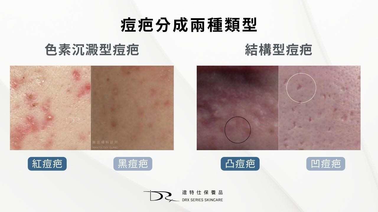 菸鹼醯胺可以淡化痘疤嗎？如何淡化痘印？