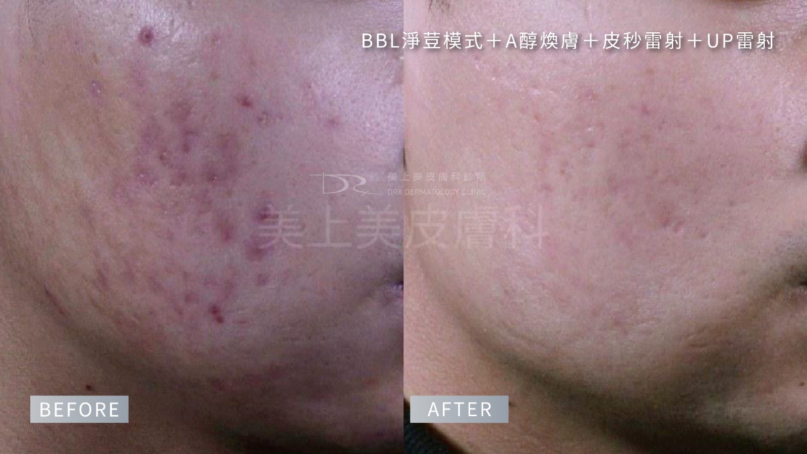 杜鵑花酸、A酸一起用:思媚乳膏用法、思麗安乳膏淡斑?紅痘疤杜鵑花酸保養方式! 杜鵑花酸、A酸一起用:思媚乳膏用法、思麗安乳膏淡斑?紅痘疤杜鵑花酸保養方式!