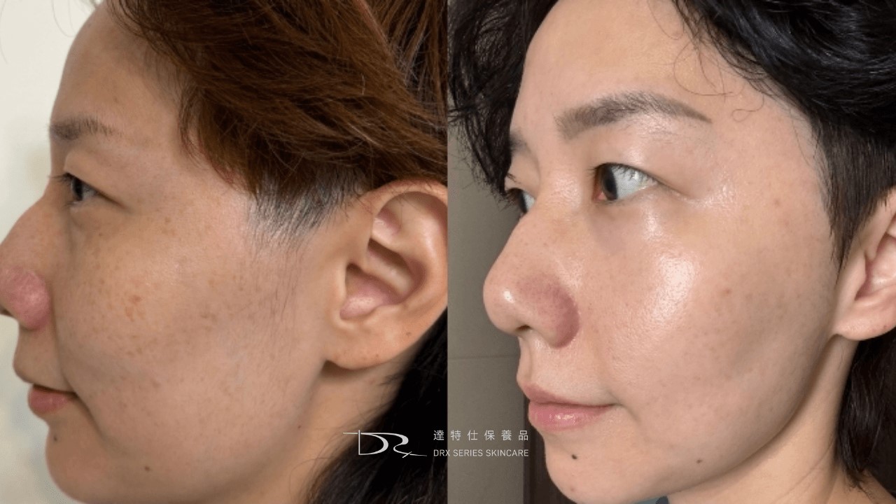 杜鵑花酸、A酸一起用:思媚乳膏用法、思麗安乳膏淡斑?紅痘疤杜鵑花酸保養方式! 杜鵑花酸、A酸一起用:思媚乳膏用法、思麗安乳膏淡斑?紅痘疤杜鵑花酸保養方式!