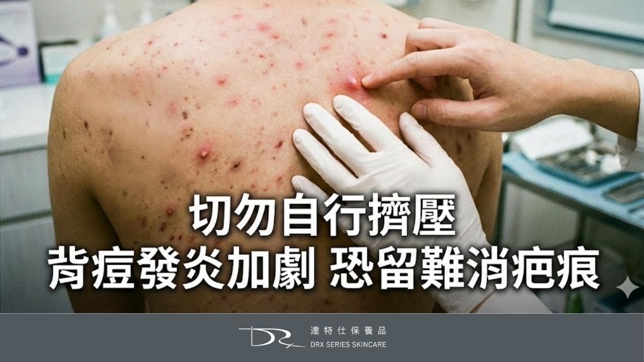 為什麼前胸後背會長痘痘？背痘原因一次解析