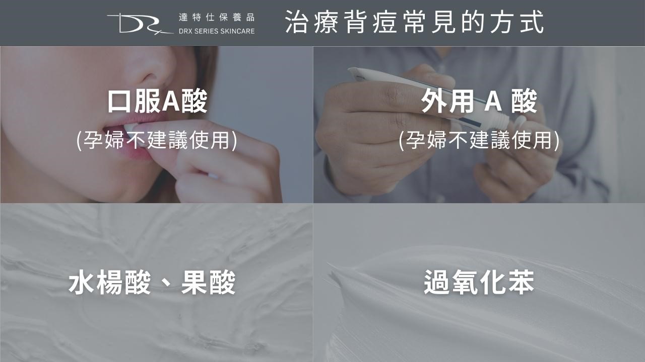 為什麼前胸後背會長痘痘？背痘原因一次解析