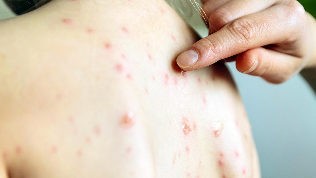 為什麼前胸後背會長痘痘？背痘原因一次解析