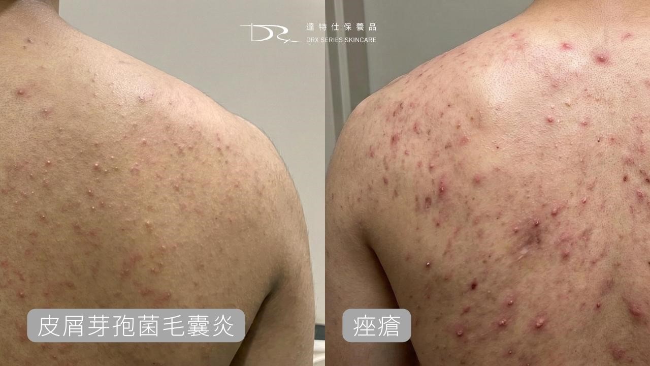 為什麼前胸後背會長痘痘？背痘原因一次解析