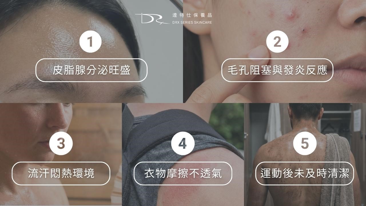 為什麼前胸後背會長痘痘？背痘原因一次解析