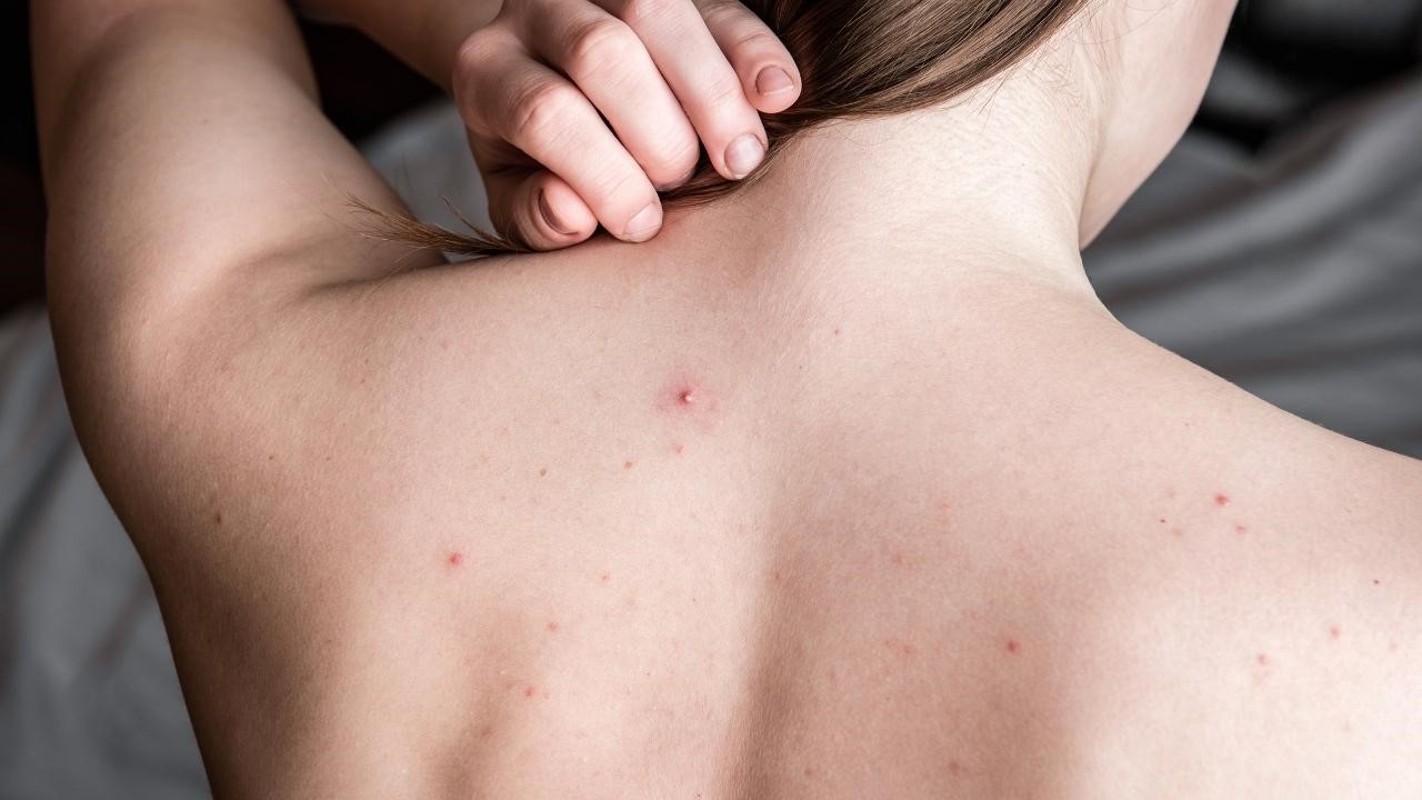 為什麼前胸後背會長痘痘？背痘原因一次解析