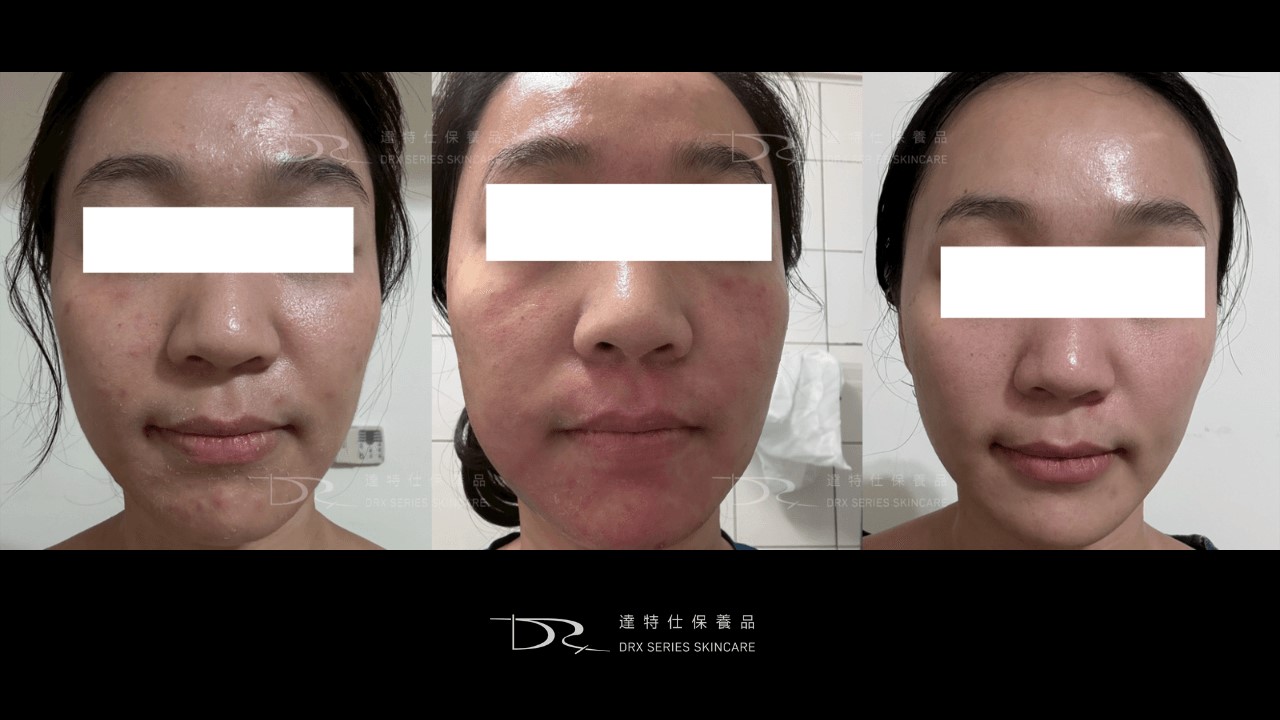 思麗安思媚與愛潔膚第一代a酸用法，一張表看懂痘痘藥膏、抗痘保養品階層，鋅痘痘有用嗎？