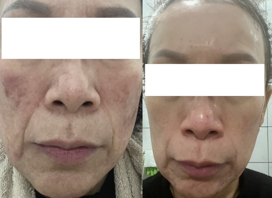 第一代A酸愛潔膚？愛潔膚用法？愛潔膚乳膏功效？