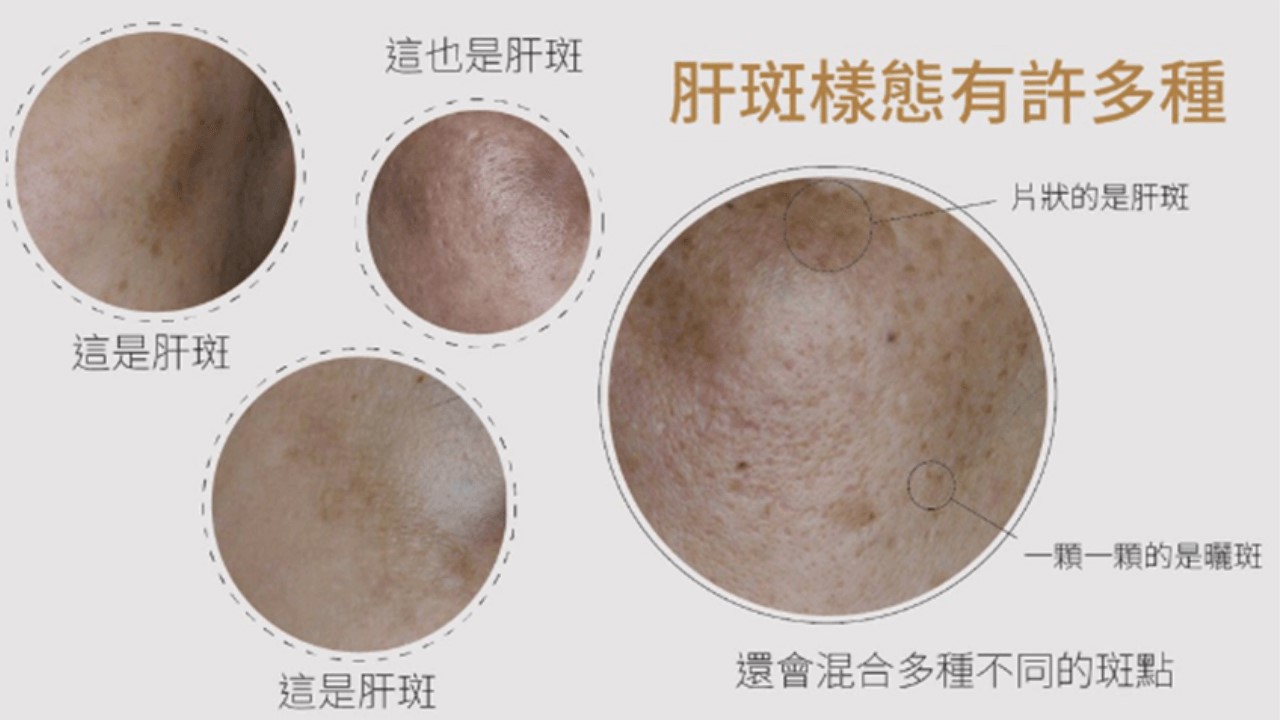 活力白乳膏有效嗎?快樂乳膏評價?對苯二酚致癌?對苯二酚反黑? 活力白乳膏有效嗎?快樂乳膏評價?對苯二酚致癌?對苯二酚反黑?