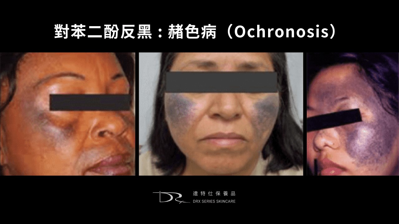 活力白乳膏有效嗎?快樂乳膏評價?對苯二酚致癌?對苯二酚反黑? 活力白乳膏有效嗎?快樂乳膏評價?對苯二酚致癌?對苯二酚反黑?