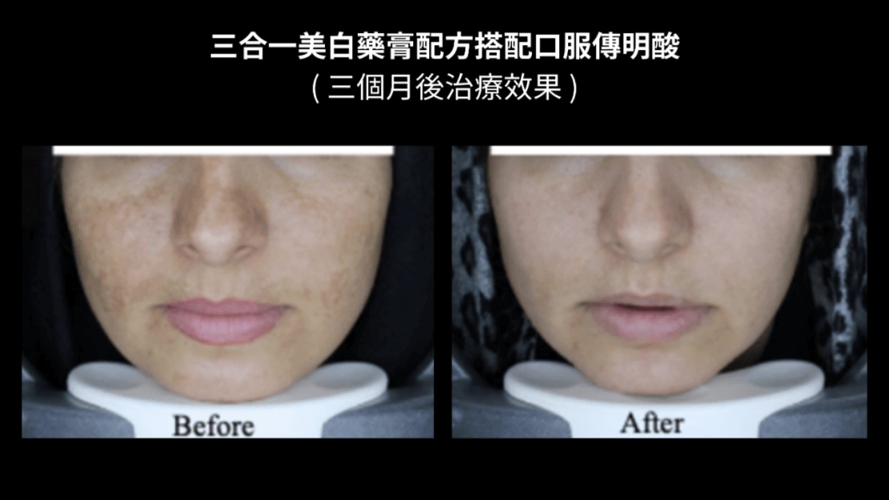 活力白乳膏有效嗎?快樂乳膏評價?對苯二酚致癌?對苯二酚反黑? 活力白乳膏有效嗎?快樂乳膏評價?對苯二酚致癌?對苯二酚反黑?