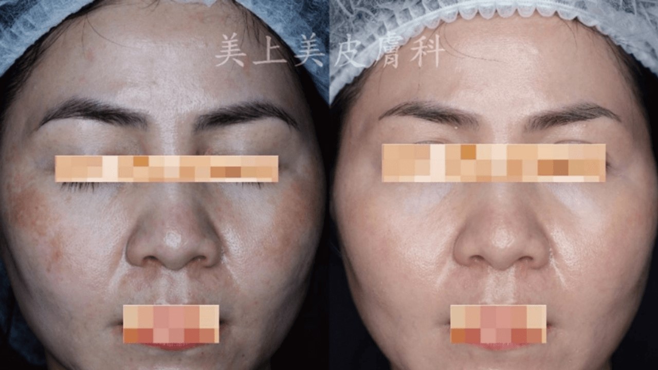 活力白乳膏有效嗎?快樂乳膏評價?對苯二酚致癌?對苯二酚反黑? 活力白乳膏有效嗎?快樂乳膏評價?對苯二酚致癌?對苯二酚反黑?