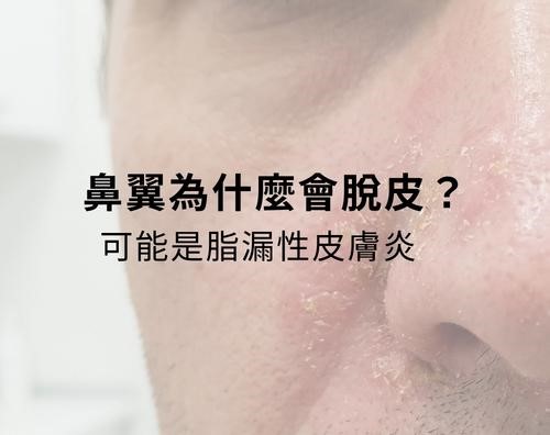 鼻翼為什麼會脫皮?可能是脂漏性皮膚炎! 鼻翼為什麼會脫皮?可能是脂漏性皮膚炎!