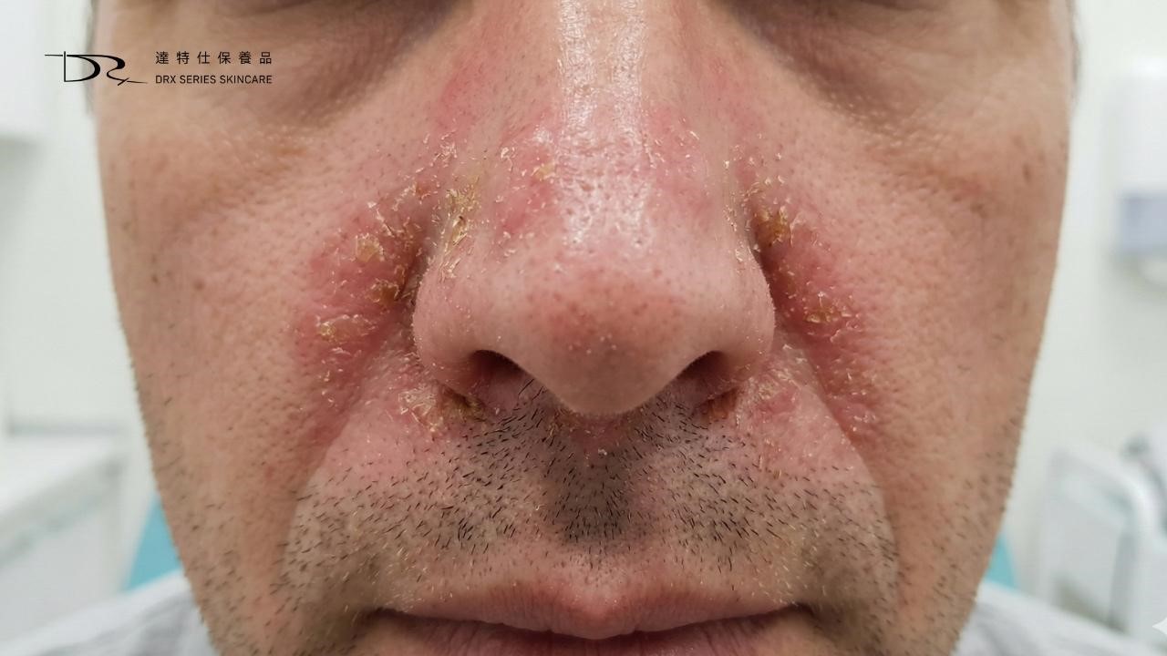 鼻翼為什麼會脫皮?可能是脂漏性皮膚炎! 鼻翼為什麼會脫皮?可能是脂漏性皮膚炎!